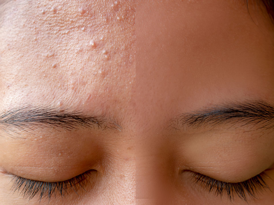 Treatment for Acne - Αντιμετώπιση ακμής με θεραπεία